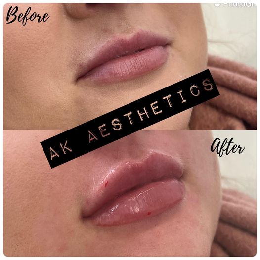 1ML LIP FILLERS